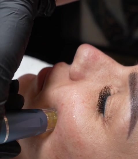 Microneedling infusion pen